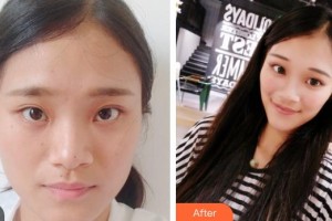 武警廣西總隊醫(yī)院醫(yī)學(xué)整形美容中心韋炳朝整形價格表附鼻部綜合案例展示