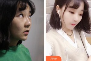 廣西中醫(yī)藥大學(xué)附屬瑞康醫(yī)院整形美容中心郭應(yīng)信整形價(jià)格表附切開雙眼皮案例展示