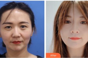 廣西中醫(yī)藥大學(xué)附屬瑞康醫(yī)院整形美容中心張素姣住院醫(yī)師整形價格表附眼部綜合案例展示