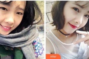 廣西中醫(yī)藥大學(xué)附屬瑞康醫(yī)院整形美容中心林忠整形價格表附切開雙眼皮案例展示