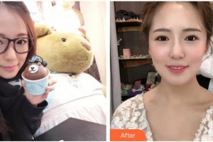 廣西東方整形美容醫(yī)院盧靜香整形價(jià)格表附金屬托槽矯正案例展示