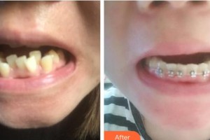 廣西科技大學(xué)第一附屬醫(yī)院骨傷整形科潘萬均整形價(jià)格表附金屬托槽矯正案例展示