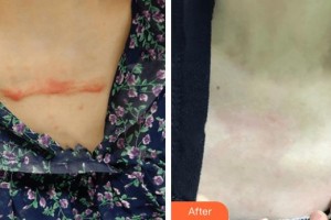 廣西科技大學(xué)第一附屬醫(yī)院骨傷整形科韋元強(qiáng)整形價(jià)格表附微創(chuàng)疤痕修復(fù)案例展示