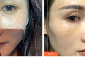 武警廣西總隊(duì)醫(yī)院醫(yī)學(xué)整形美容中心隋長清整形價(jià)格表附激光祛斑案例展示