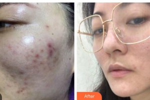 廣西東方整形美容醫(yī)院楊競忠整形價(jià)格表附去痘印痘坑案例展示