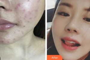 武警廣西總隊醫(yī)院醫(yī)學(xué)整形美容中心董小飛整形價格表附紅藍(lán)光祛痘案例展示