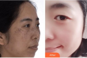 廣西科技大學(xué)第一附屬醫(yī)院骨傷整形科楊建德整形價格表附激光祛斑案例展示