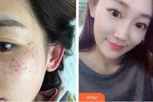 廣西愛思特整形外科醫(yī)院蘇英整形價格表附激光祛斑案例展示