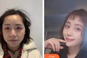 廣西東方整形美容醫(yī)院于曉倩整形價格表附埋線提升案例展示