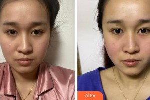 廣西帝醫(yī)醫(yī)療美容門診部林山整形價格表附外切祛眼袋案例展示