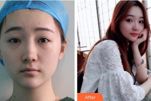 廣西廣麗醫(yī)療美容醫(yī)院劉明整形價格表附定點雙眼皮案例展示