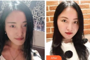 廣西來賓愛爾眼科醫(yī)院梁玉耕整形價格表附眼部綜合案例展示