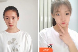 廣西愛思特整形外科醫(yī)院韋強整形價格表附眼部綜合案例展示