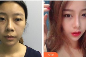 廣西東方整形美容醫(yī)院覃新月整形價格表附激光去眼袋案例展示