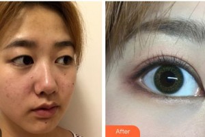 柳州愛爾眼科醫(yī)院黃俊豪整形價格表附眼部綜合案例展示