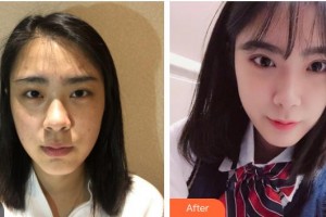 柳州紅十字會眼科醫(yī)院陽橋生整形價格表附切開雙眼皮案例展示