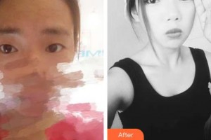 柳州市柳鐵中心醫(yī)院燒傷整形外科林嘉昕整形價格表附切開雙眼皮案例展示