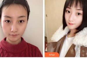 柳州市中醫(yī)醫(yī)院眼科寧作蓮住院醫(yī)師整形價格表附定點雙眼皮案例展示