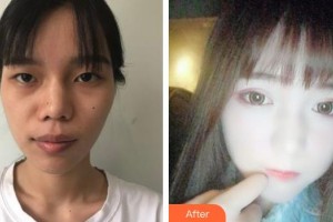 柳州市中醫(yī)醫(yī)院眼科李靜波整形價格表附眼部綜合案例展示