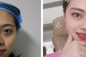 柳州市中醫(yī)醫(yī)院眼科趙耀整形價格表附眼部綜合案例展示