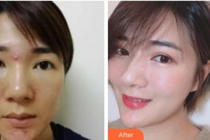 柳州市中醫(yī)醫(yī)院眼科劉祁廣整形價格表附激光去眼袋案例展示