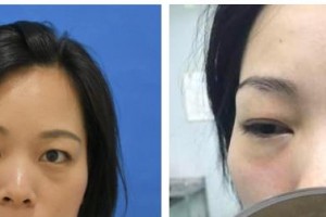 桂林市人民醫(yī)院眼科蔡濤整形價格表附眼部綜合案例展示