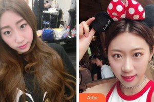 桂林市人民醫(yī)院眼科岳靜整形價格表附外切祛眼袋案例展示