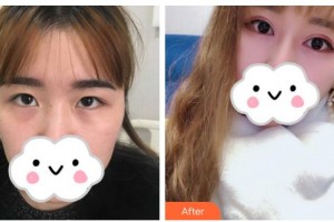 桂林市人民醫(yī)院眼科錢錦芳整形價格表附眼部綜合案例展示