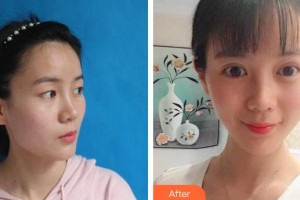 桂林市人民醫(yī)院眼科李毅宏整形價格表附眼部綜合案例展示