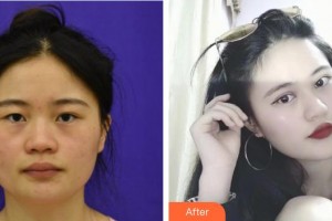 桂林市中醫(yī)醫(yī)院眼科李民堅整形價格表附切開雙眼皮案例展示