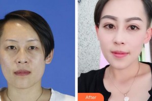 桂林市中醫(yī)醫(yī)院眼科楊小凡整形價格表附切開雙眼皮案例展示