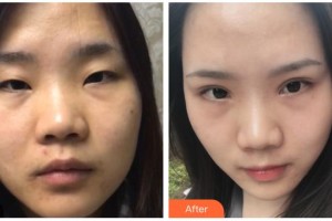 梧州市工人醫(yī)院眼科陸華文整形價(jià)格表附切開(kāi)雙眼皮案例展示