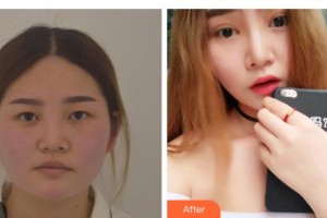 梧州市工人醫(yī)院眼科賀瑋整形價(jià)格表附切開(kāi)雙眼皮案例展示