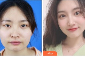 梧州市工人醫(yī)院眼科趙夏海整形價(jià)格表附切開(kāi)雙眼皮案例展示