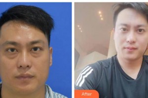 北海博鏵醫(yī)院整形美容中心趙弘宇整形價(jià)格表附激光去眼袋案例展示