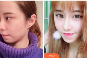 北海韓美醫(yī)療美容門(mén)診部鐘舉然整形價(jià)格表附眼部綜合案例展示