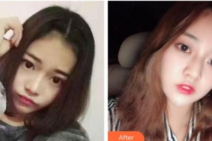 北海韓美醫(yī)療美容門(mén)診部劉秀艷整形價(jià)格表附眼部綜合案例展示