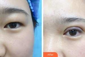 北海華美醫(yī)療美容診所郎煒慧整形價格表附眼部綜合案例展示