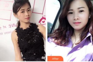 欽州市第二人民醫(yī)院眼科李艷春整形價(jià)格表附激光去眼袋案例展示