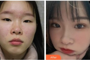 貴港愛(ài)爾眼科醫(yī)院唐健青整形價(jià)格表附眼部綜合案例展示