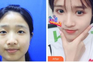 貴港愛(ài)爾眼科醫(yī)院吳香蓮整形價(jià)格表附眼部綜合案例展示