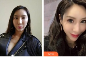 貴港愛(ài)爾眼科醫(yī)院潘可生整形價(jià)格表附切開(kāi)雙眼皮案例展示