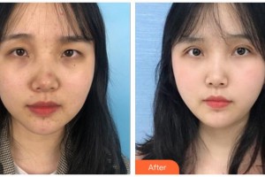 玉林華美整形美容醫(yī)院樸洪權整形價格表附眼部綜合案例展示