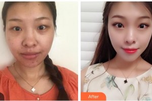 玉林華美整形美容醫(yī)院劉慧整形價格表附眼部綜合案例展示