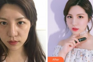 玉林愛爾眼科醫(yī)院盧榮強整形價格表附眼部修復案例展示