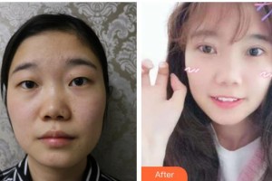 玉林愛爾眼科醫(yī)院李平整形價格表附切開雙眼皮案例展示