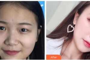 玉林愛爾眼科醫(yī)院張熙健整形價格表附眼部綜合案例展示