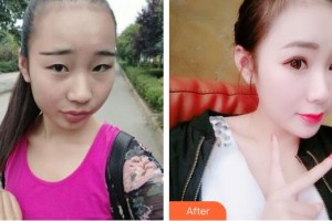 玉林時光醫(yī)療美容醫(yī)院吳克威整形價格表附定點雙眼皮案例展示