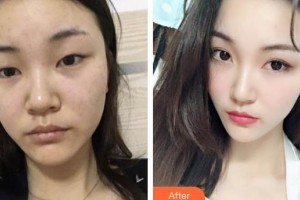 玉林愛爾眼科醫(yī)院王碧華整形價格表附眼部綜合案例展示