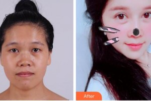 玉林愛爾眼科醫(yī)院黃瓊球整形價格表附定點雙眼皮案例展示